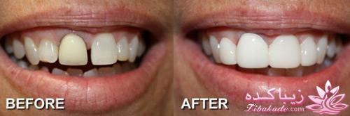 روکش های زیبایی دندان