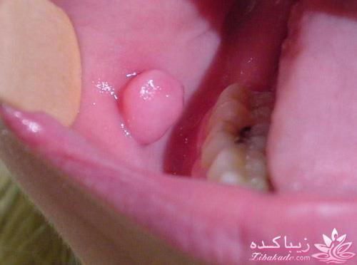ضایعات و تومورهای خوش خیم حفره دهان