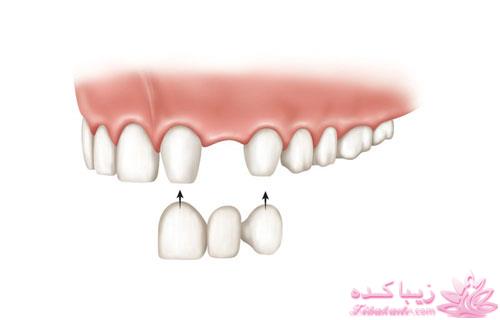 انواع روشهای جایگزینی دندان از دست رفته