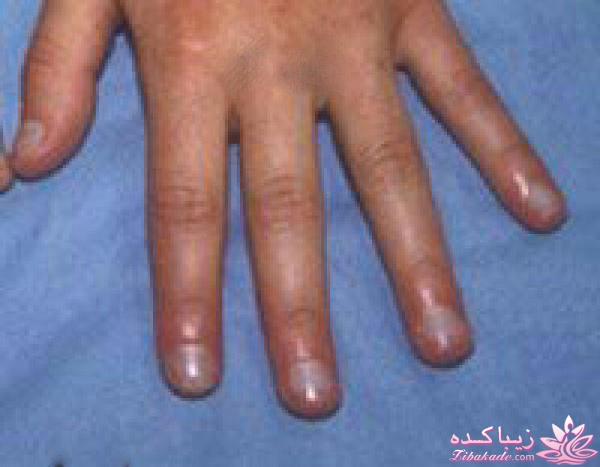 تشخیص بیماری با ناخن 