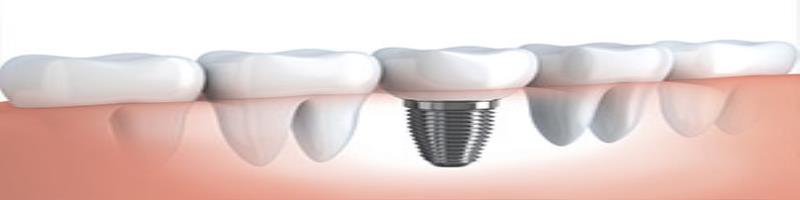 کاور ایمپلنت دندان