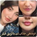 تزریق ژل لب