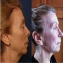 جوانسازی و رفع چین و چروک صورت