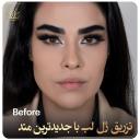 تزریق ژل لب