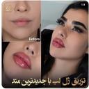 تزریق ژل لب در تهران