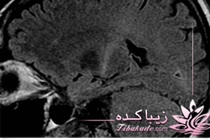 بیماری ای ال اس