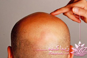 طاس، کچل، مو، سر