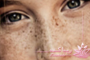 لک، کک، مک، درمان، بارداری