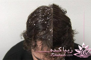 شوره، سر، درمان