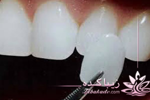 مینا، دندان، لثه، تقویت، مسواک، فلوراید