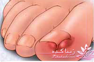 ناخن، انگشت، درمان