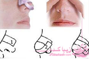 جراحی , بینی