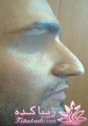 جراحی بینی - جراحی زیبایی