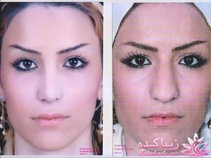 جراحی بینی - جراحی زیبایی