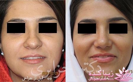 جراحی بینی - جراحی زیبایی