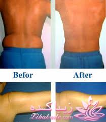 لیپولیز - لیپوماتیک - لیپوساکشن