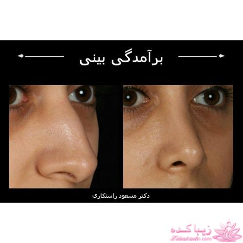 جراحی بینی - جراحی زیبایی