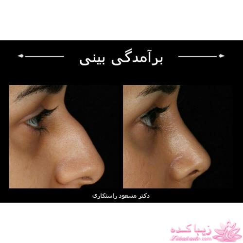 جراحی بینی - جراحی زیبایی