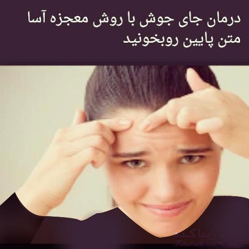 درمان جای جوش