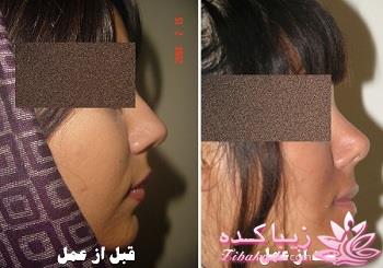 جراحی بینی - جراحی زیبایی