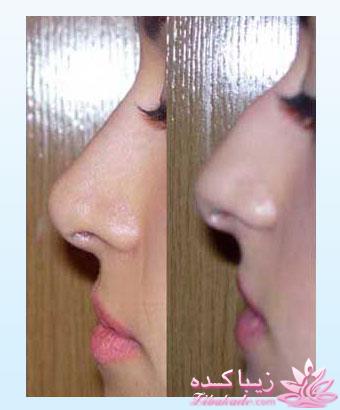 جراحی بینی - جراحی زیبایی