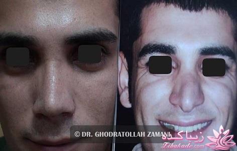 جراحی بینی - جراحی زیبایی