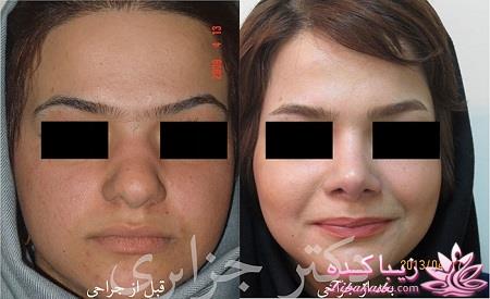 جراحی بینی - جراحی زیبایی