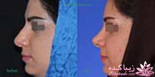 جراحی بینی - جراحی زیبایی
