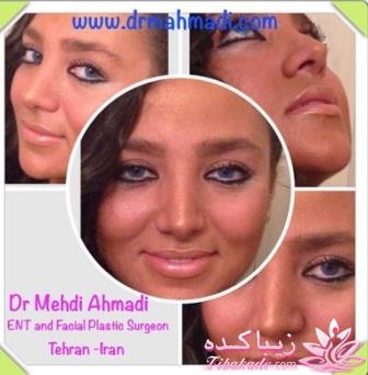 جراحی بینی - جراحی زیبایی