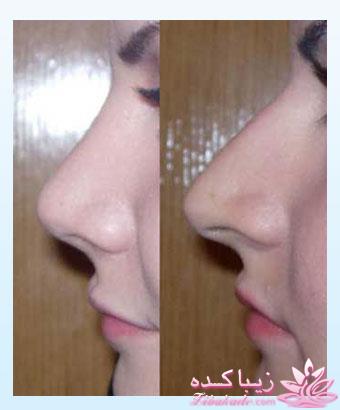 جراحی بینی - جراحی زیبایی