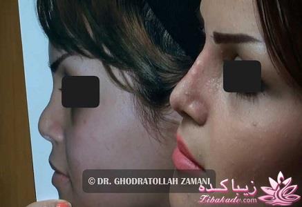 جراحی بینی - جراحی زیبایی