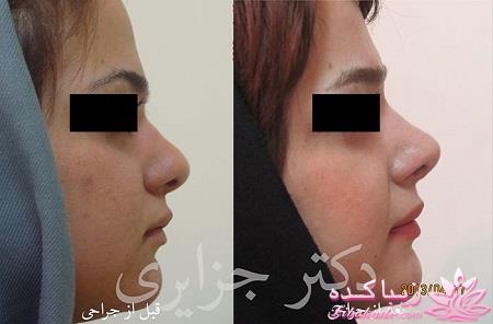 جراحی بینی - جراحی زیبایی