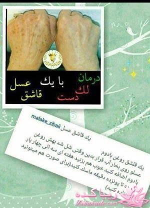 از بین بردن لک های دست به روش طبیعی