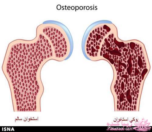 تاثیر رضایت از زندگی بر حفظ سلامت استخوانهای زنان مسن