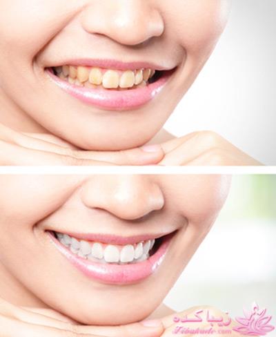 چه افرادی نباید به دنبال سفید کردن دندانها باشند؟