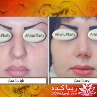 جراحی  زیبایی بینی