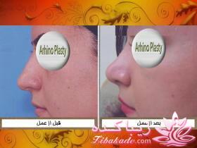 جراحی  زیبایی بینی