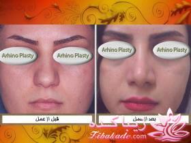 جراحی  زیبایی بینی