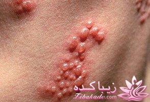 بیماری زونا را از نشانه هایش زود تشخیص دهید