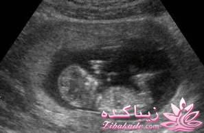 معرفی تست های غربالگری زمان بارداری