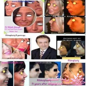 عوارض جراحى رینوپلاستى چیست ؟