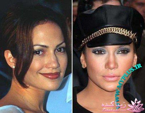 جراحی بینی - جراحی زیبایی