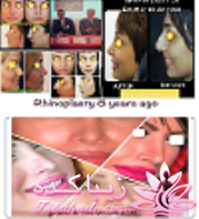 جراحی بینی - جراحی زیبایی