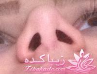 جراحی بینی - جراحی زیبایی