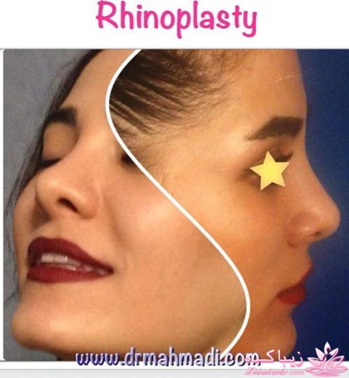 جراحی بینی - جراحی زیبایی