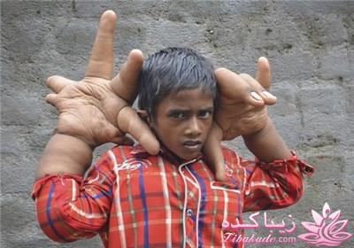 تصاویر پسر هندی با دستانی غول آسا