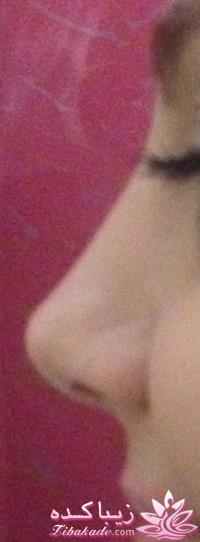 جراحی بینی - جراحی زیبایی