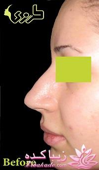 جراحی بینی - جراحی زیبایی