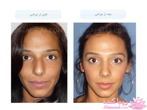 جراحی بینی - جراحی زیبایی