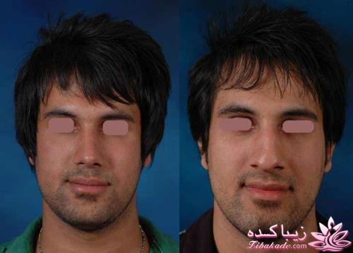 جراحی بینی - جراحی زیبایی